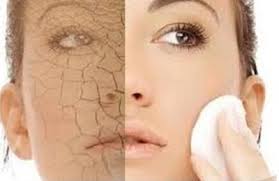 dry skin